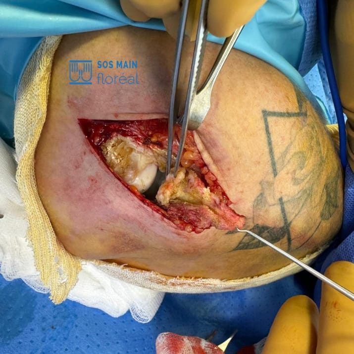 reparation tendon epicondylite