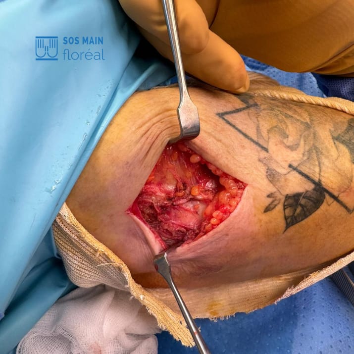 suture tendon epicondylite