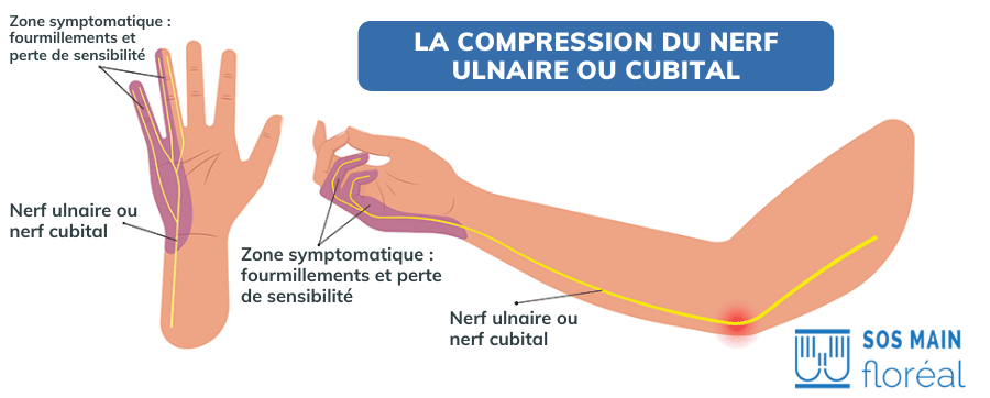 symptomes nerf cubital