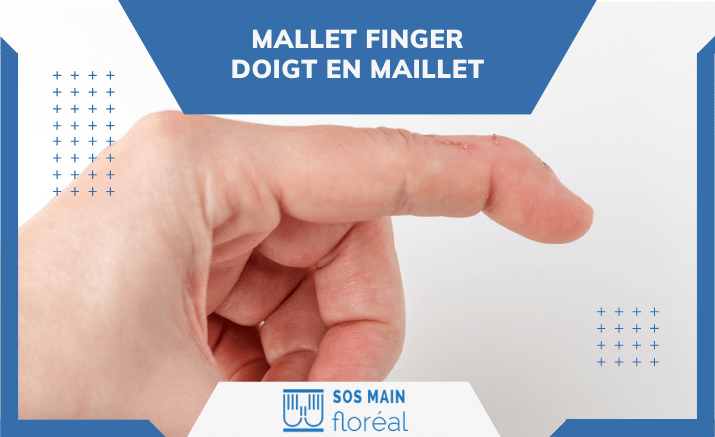 Mallet finger : symptômes, diagnostic et traitements