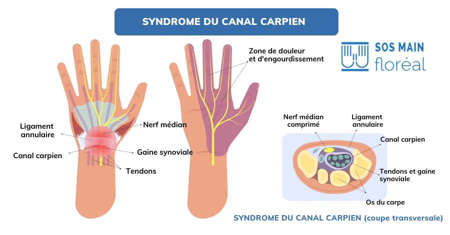 canal carpien infographie