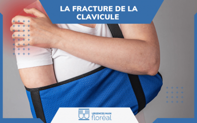 Fracture de la clavicule : symptômes, diagnostic et traitements