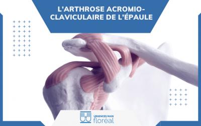 Arthrose acromio-claviculaire de l’épaule : symptômes, diagnostic et traitements