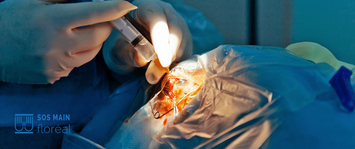 chirurgie arthrose acromio claviculaire épaule