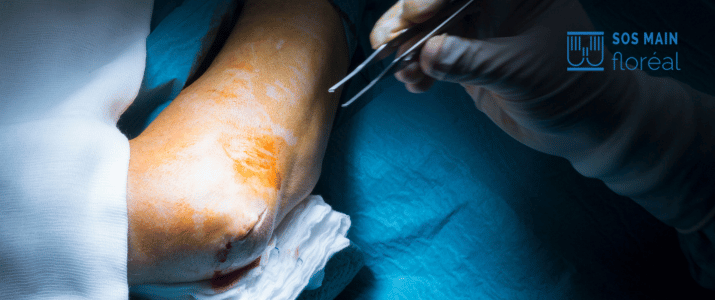 hygroma coude chirurgie