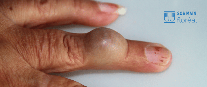 Kyste mucoïde du doigt : traitement naturel ou chirurgical ?