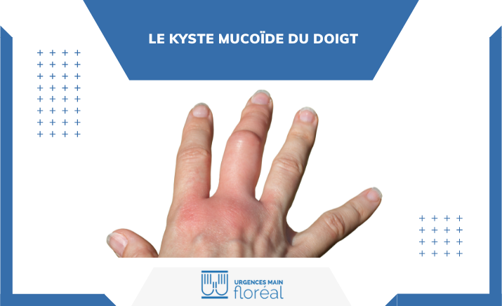 Le kyste mucoïde du doigt : causes et traitements