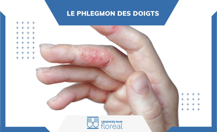 Le phlegmon des doigts : une infection grave à ne pas négliger