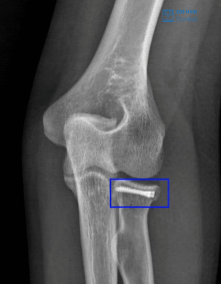ostéosynthèse fracture radiale
