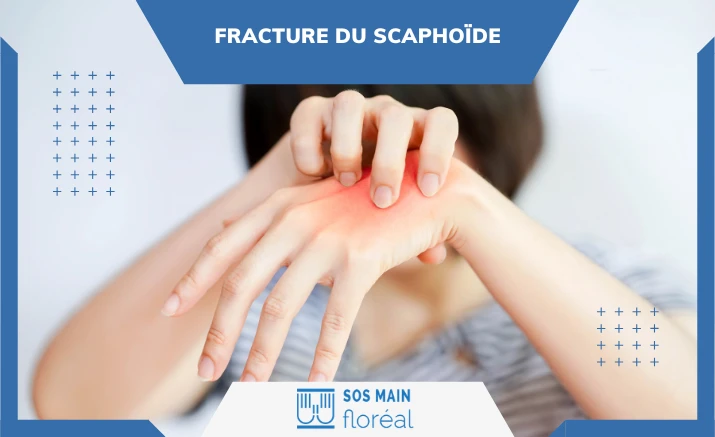 Fracture du scaphoïde