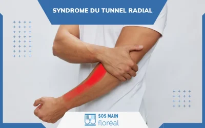 Nos actualités 3 Syndrome du tunnel radial : diagnostic et prise en charge