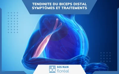 Nos actualités 2 Tendinite du biceps distal : symptômes et traitements