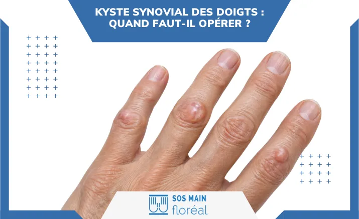 Kyste synovial des doigts